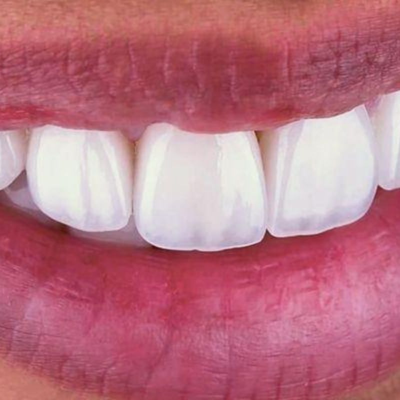 Smile design result — case 1