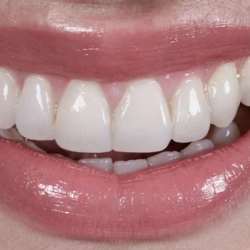Smile design result — case 2