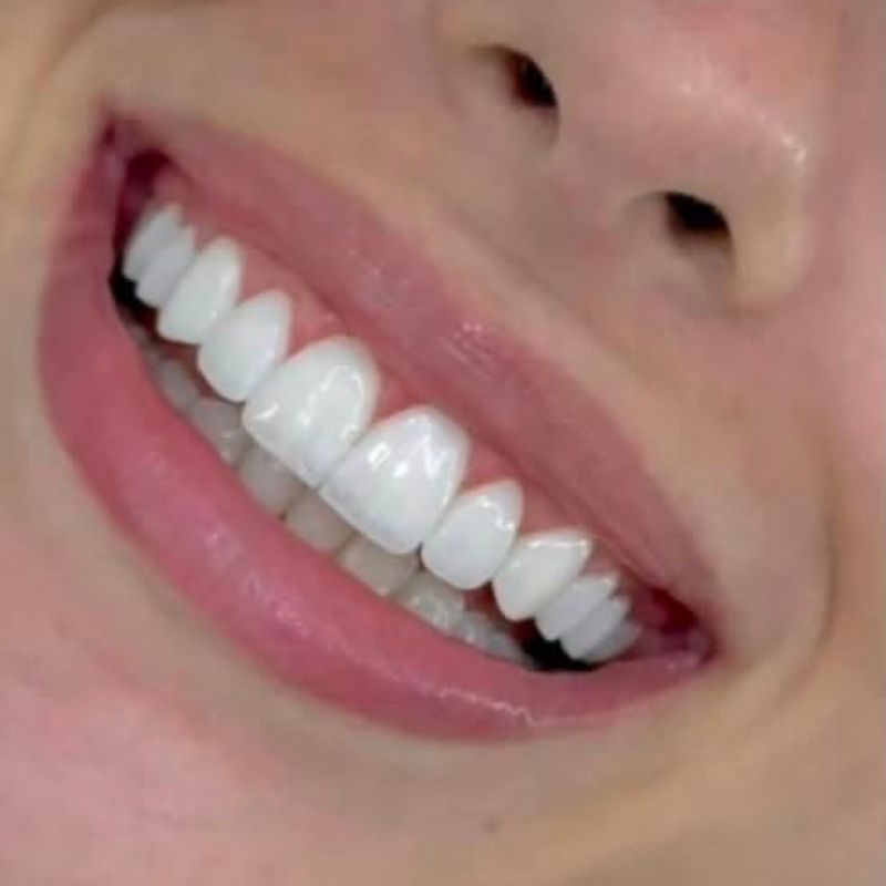 Smile design result — case 3