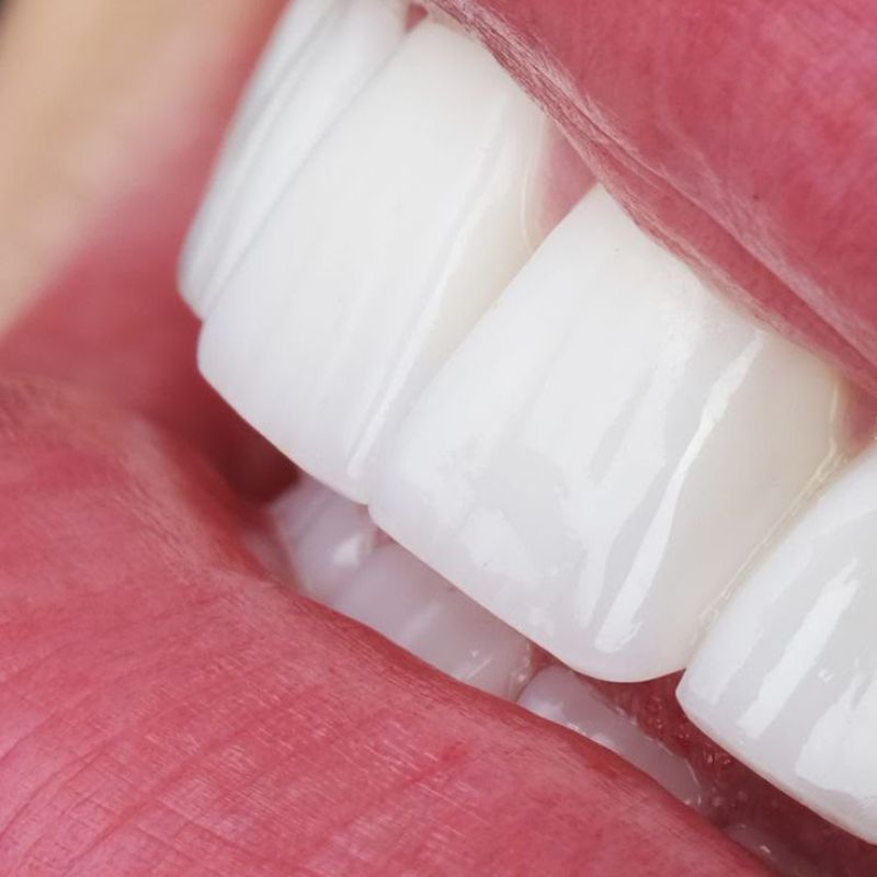 Smile design result — case 4