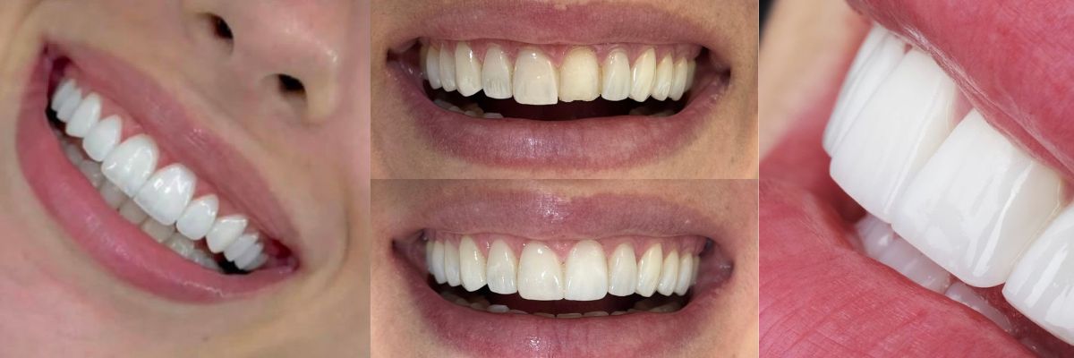 Resultado de diseño de sonrisa en OV Dental Studio