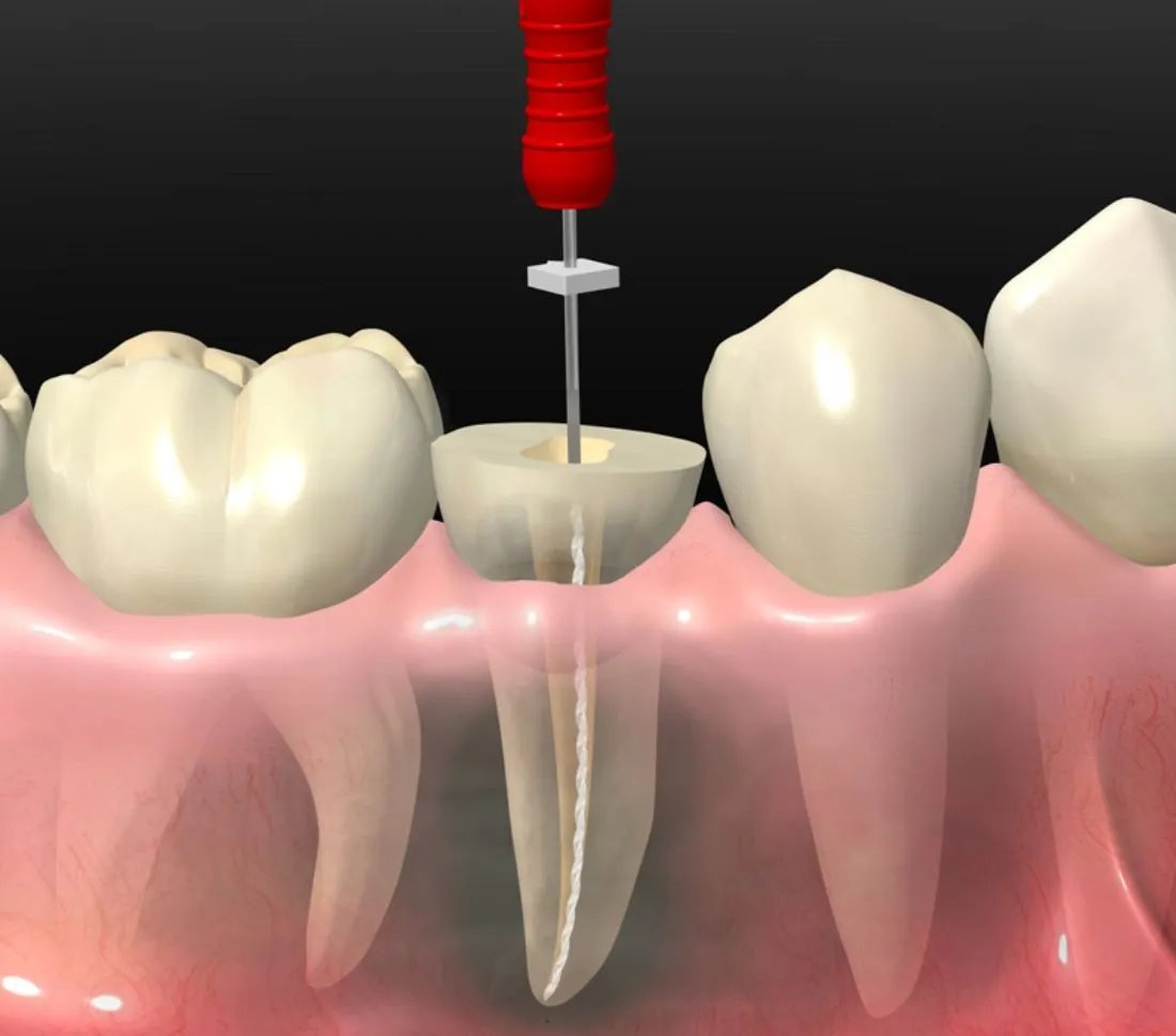 Endodoncia en OV Dental Studio