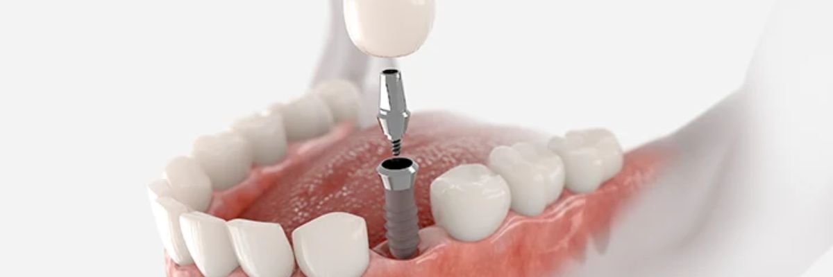 Materiales de implante dental de primer nivel