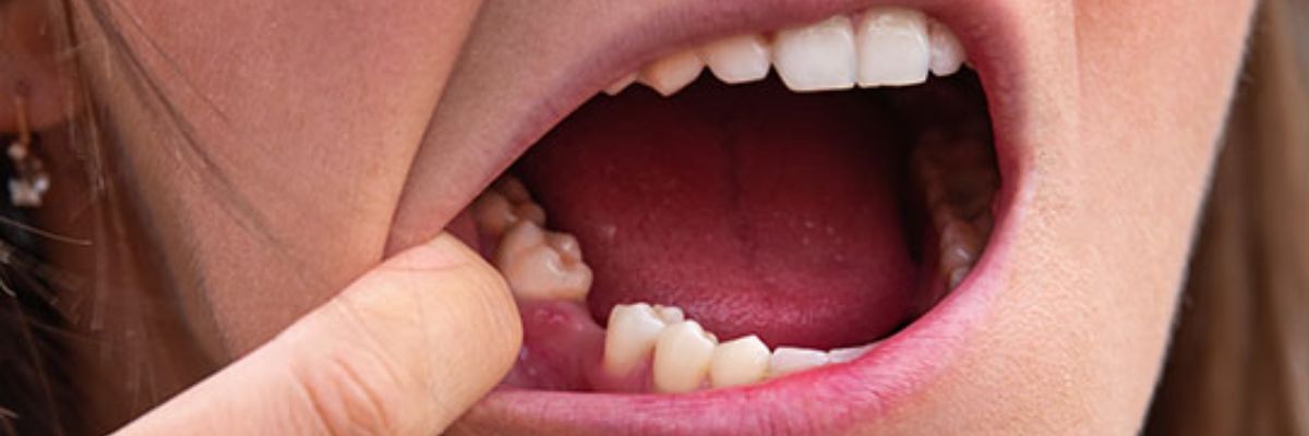 Paciente en consulta de implantes dentales en OV Dental Studio